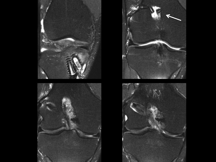 Figure 5 for case ACL graft device ( RID5523 )